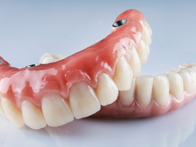 Prótese Dentária: Quais os Tipos Disponíveis e Como Escolher a Melhor?