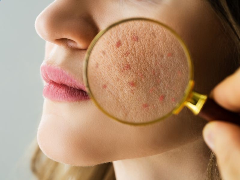 Acne: Como o Dermatologista Pode Ajudar no Tratamento?