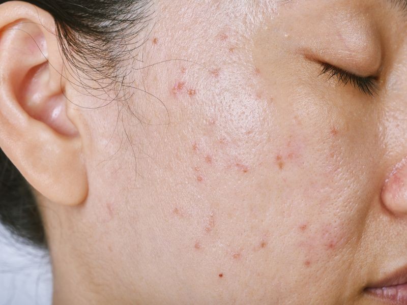 Acne: Como o Dermatologista Pode Ajudar no Tratamento?